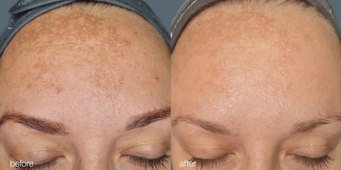 My Melanopro Peel Journey: A Summer of Transformation